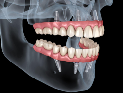 Why A Diagnostic Tooth Setup Matters Before Full Arch Replacement